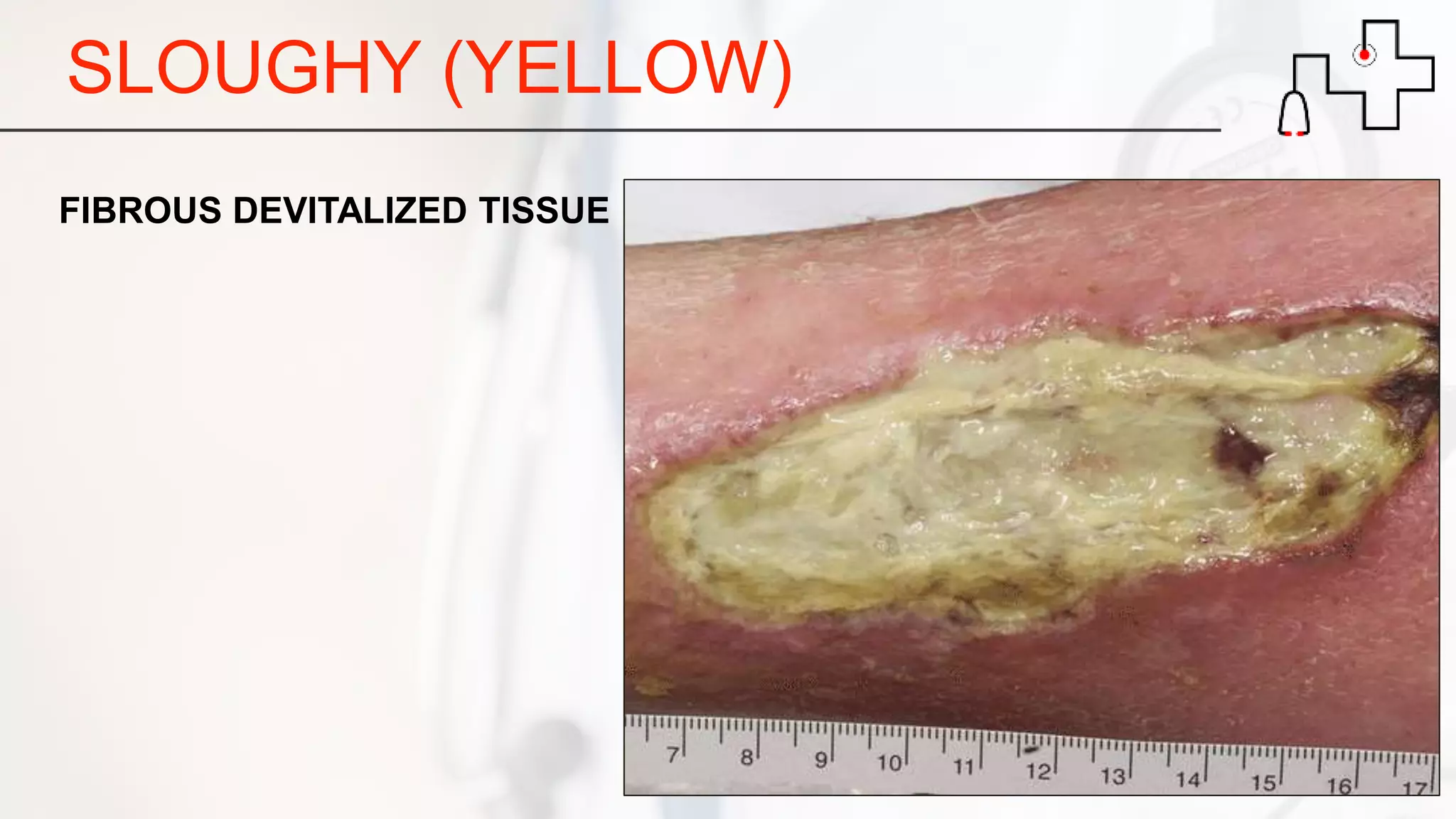 SLOUGHY (YELLOW)
FIBROUS DEVITALIZED TISSUE
 