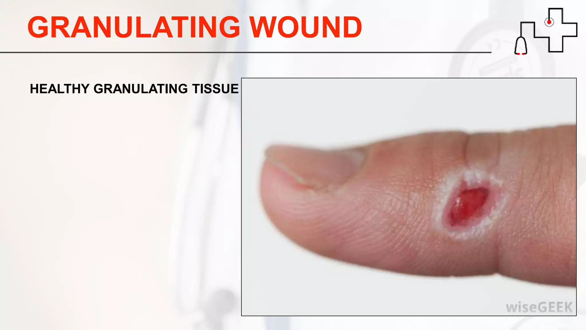 GRANULATING WOUND
HEALTHY GRANULATING TISSUE
 