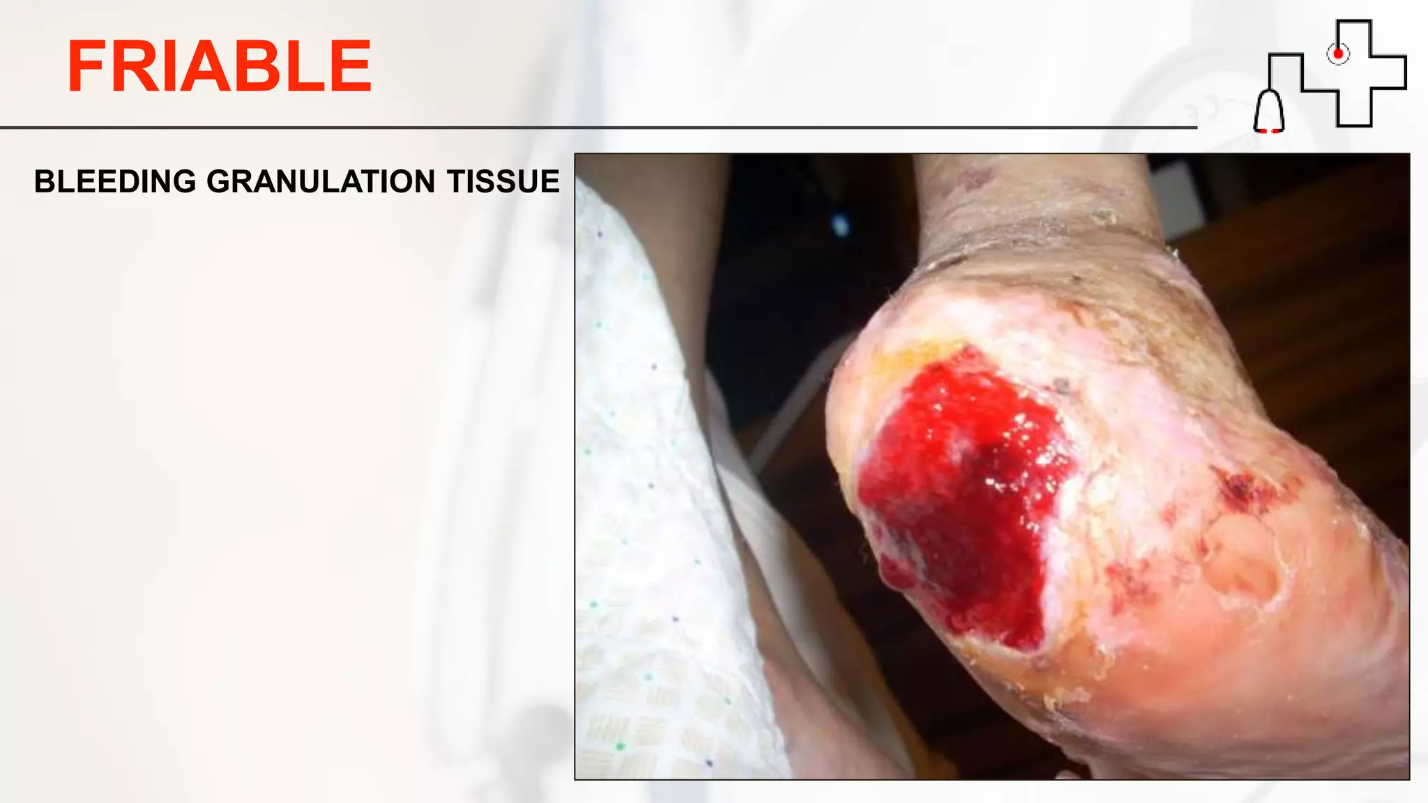 FRIABLE
BLEEDING GRANULATION TISSUE
 