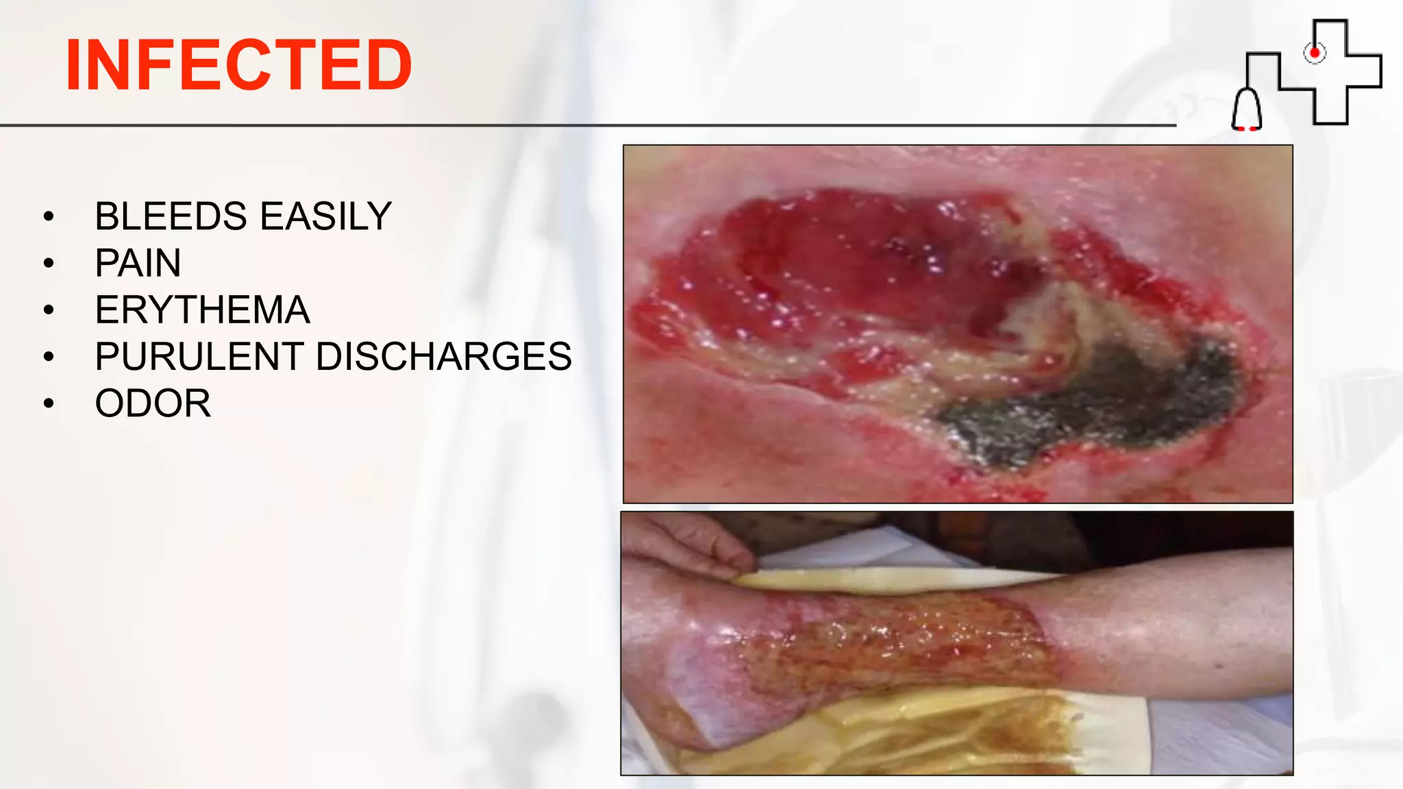 INFECTED
• BLEEDS EASILY
• PAIN
• ERYTHEMA
• PURULENT DISCHARGES
• ODOR
 