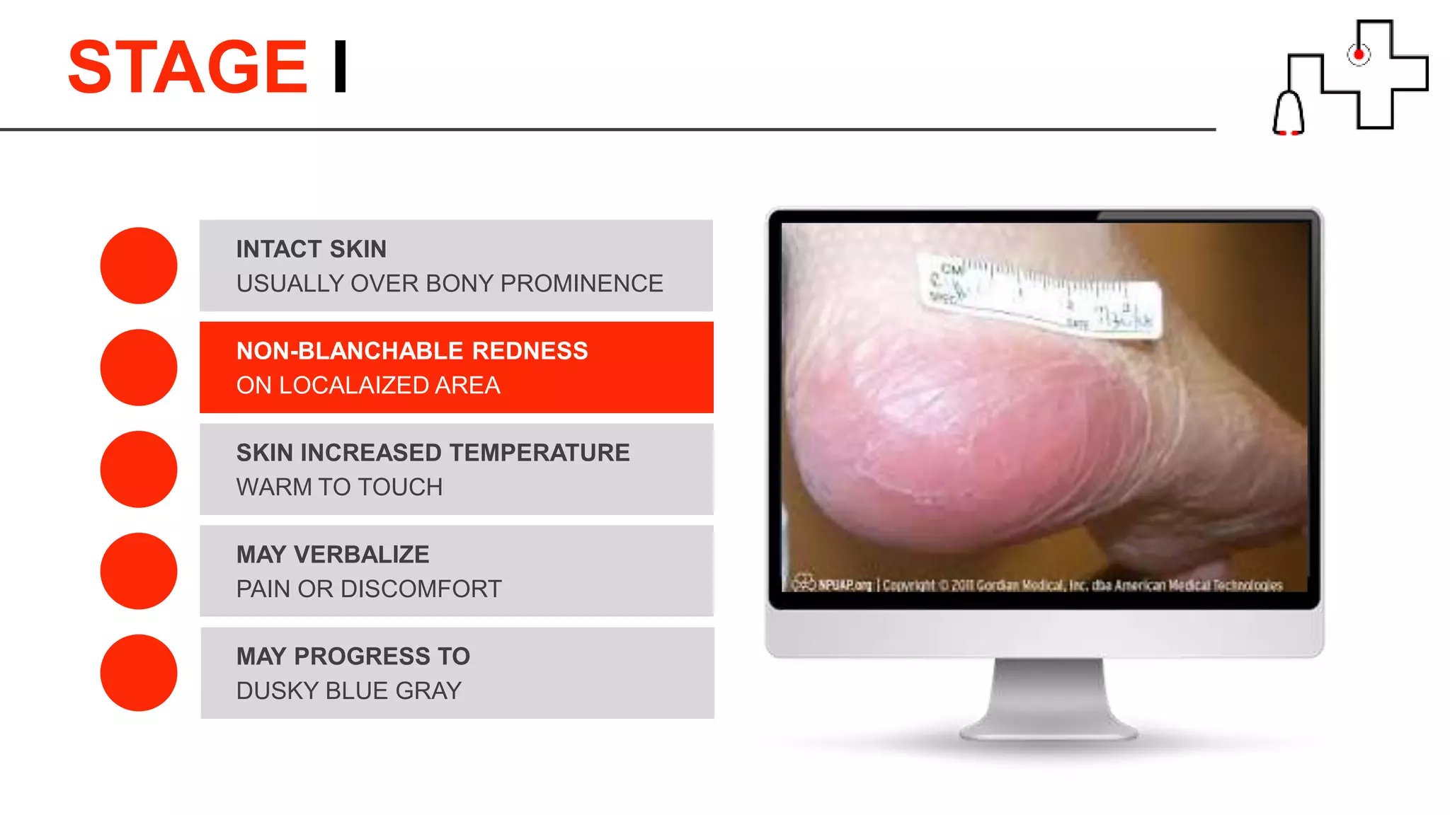 STAGE l
USUALLY OVER BONY PROMINENCE
INTACT SKIN
ON LOCALAIZED AREA
NON-BLANCHABLE REDNESS
WARM TO TOUCH
SKIN INCREASED TEMPERATURE
DUSKY BLUE GRAY
MAY PROGRESS TO
PAIN OR DISCOMFORT
MAY VERBALIZE
 
