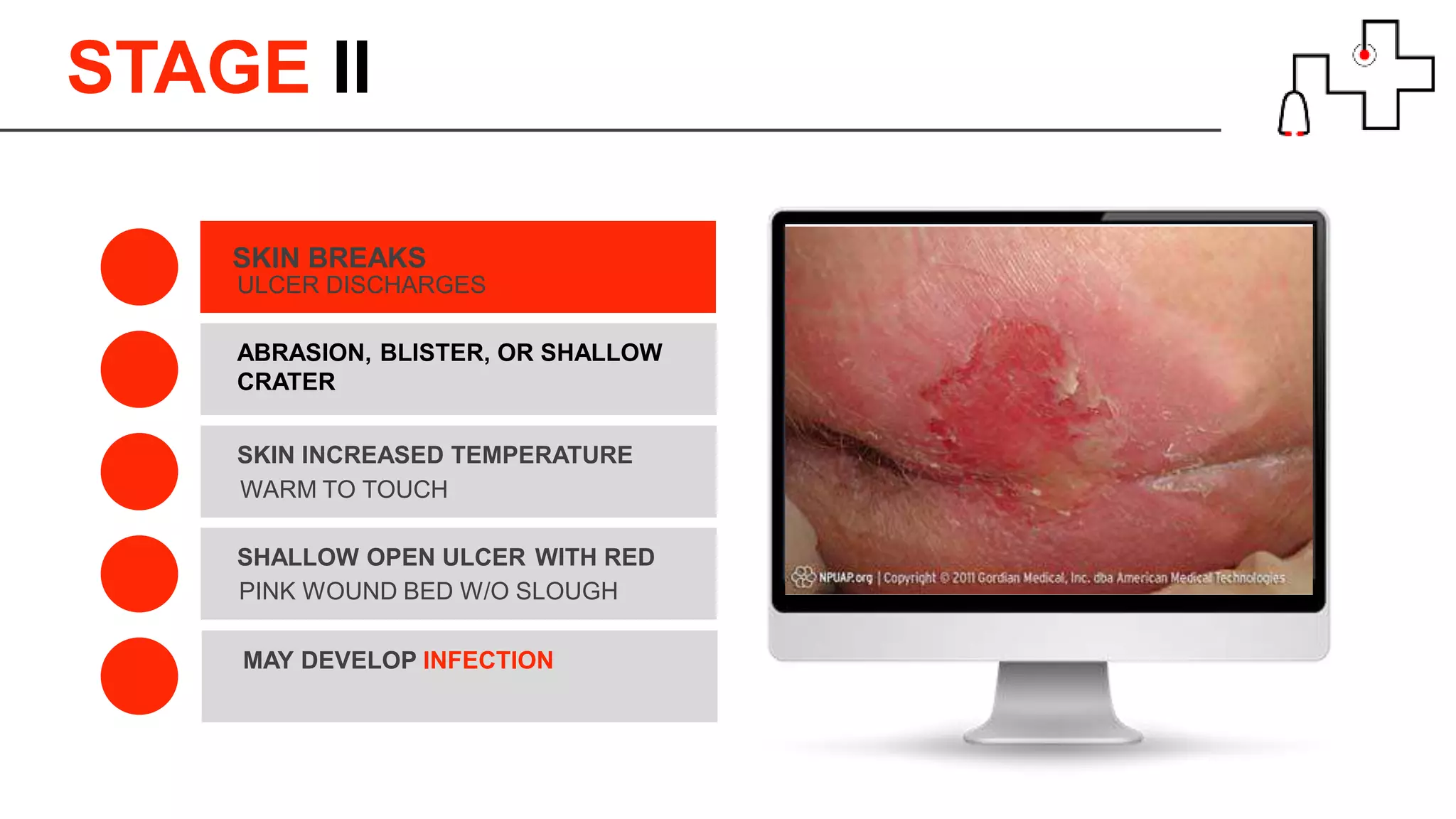 STAGE ll
ULCER DISCHARGES
SKIN BREAKS
ABRASION, BLISTER, OR SHALLOW
CRATER
WARM TO TOUCH
SKIN INCREASED TEMPERATURE
MAY DEVELOP INFECTION
PINK WOUND BED W/O SLOUGH
SHALLOW OPEN ULCER WITH RED
 