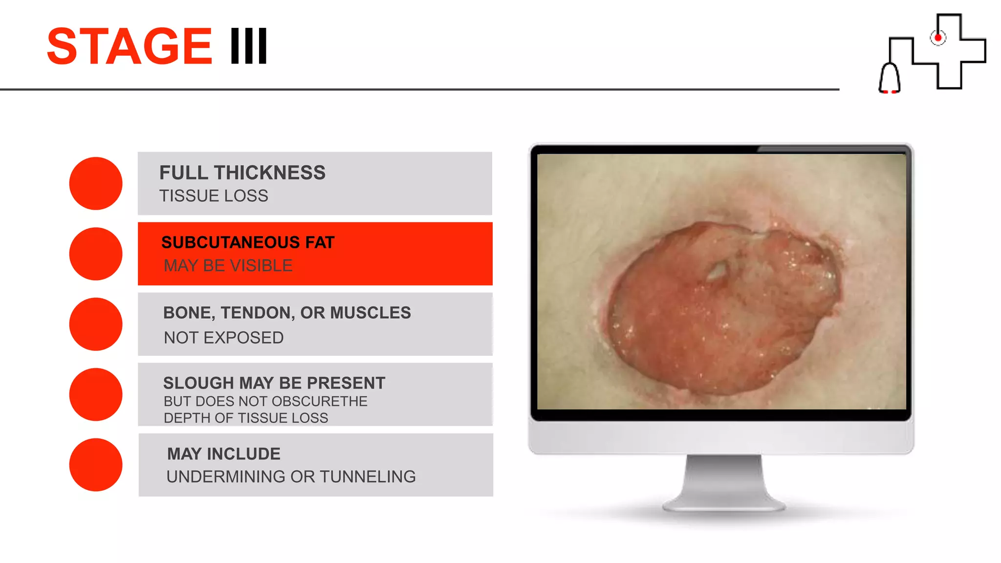 STAGE lll
TISSUE LOSS
FULL THICKNESS
SUBCUTANEOUS FAT
NOT EXPOSED
BONE, TENDON, OR MUSCLES
UNDERMINING OR TUNNELING
MAY INCLUDE
BUT DOES NOT OBSCURETHE
DEPTH OF TISSUE LOSS
SLOUGH MAY BE PRESENT
MAY BE VISIBLE
 