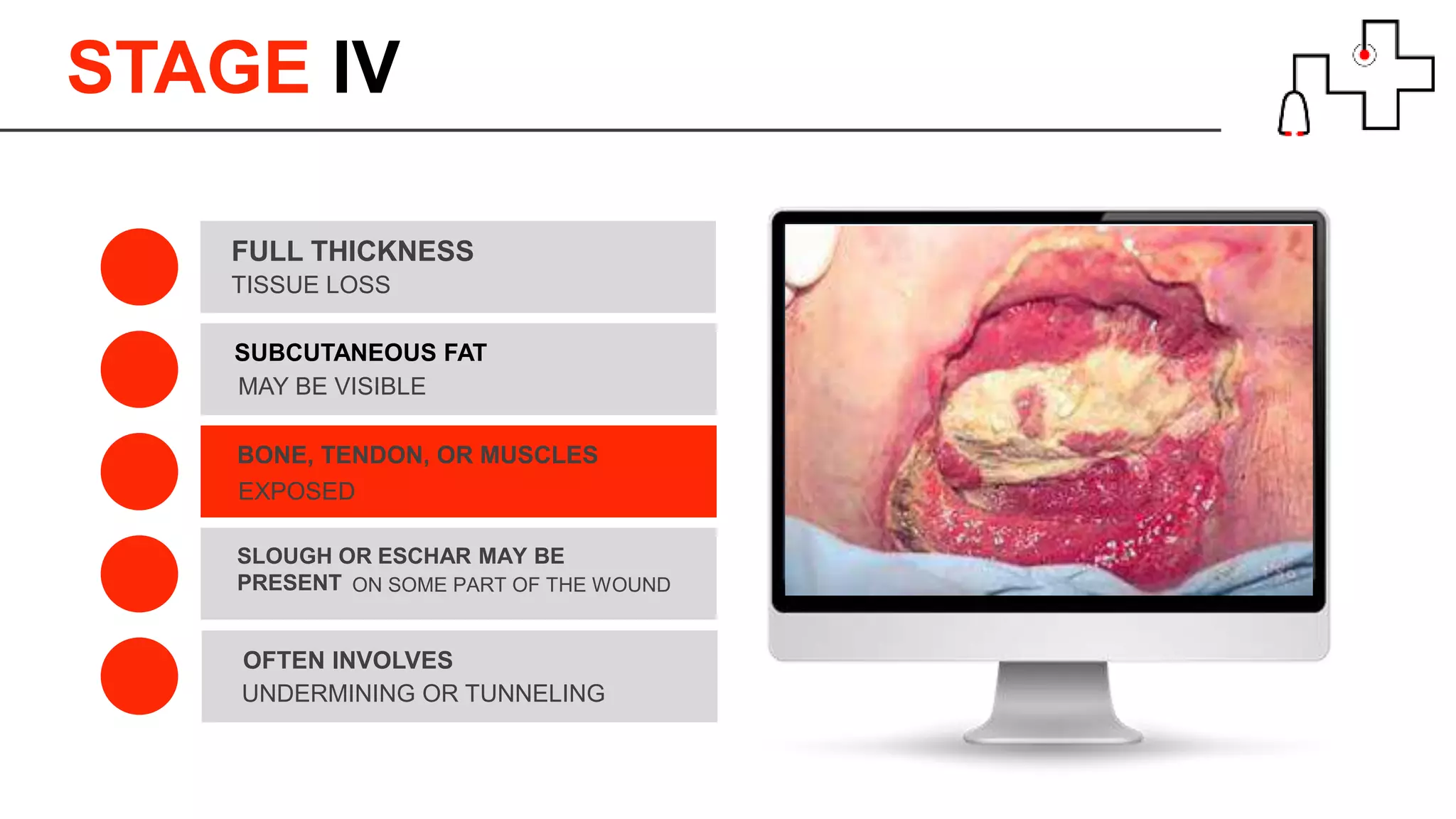STAGE lV
TISSUE LOSS
FULL THICKNESS
SUBCUTANEOUS FAT
EXPOSED
BONE, TENDON, OR MUSCLES
UNDERMINING OR TUNNELING
OFTEN INVOLVES
ON SOME PART OF THE WOUND
SLOUGH OR ESCHAR MAY BE
PRESENT
MAY BE VISIBLE
 