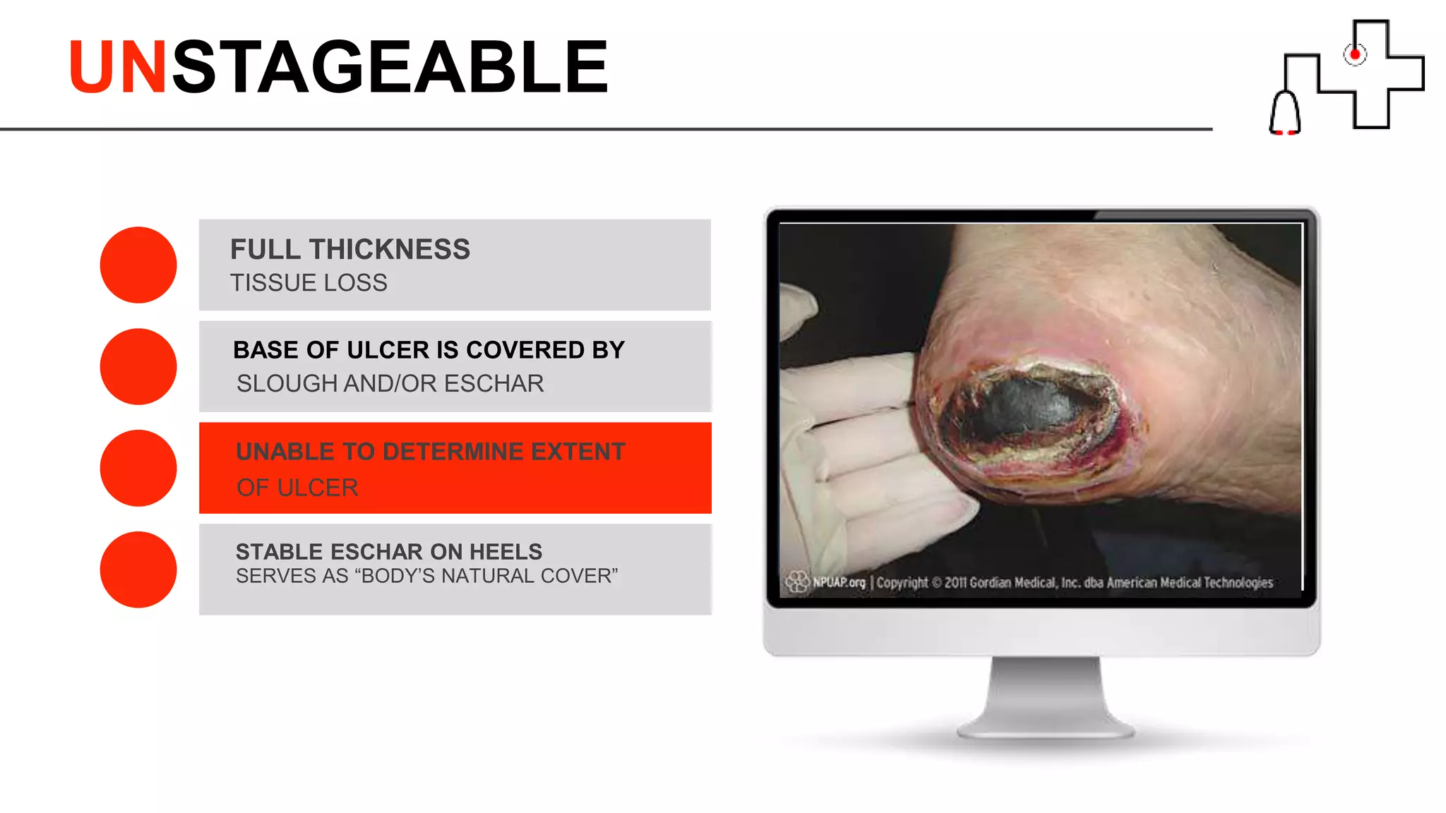 UNSTAGEABLE
TISSUE LOSS
FULL THICKNESS
BASE OF ULCER IS COVERED BY
OF ULCER
UNABLE TO DETERMINE EXTENT
SERVES AS “BODY’S NATURAL COVER”
STABLE ESCHAR ON HEELS
SLOUGH AND/OR ESCHAR
 