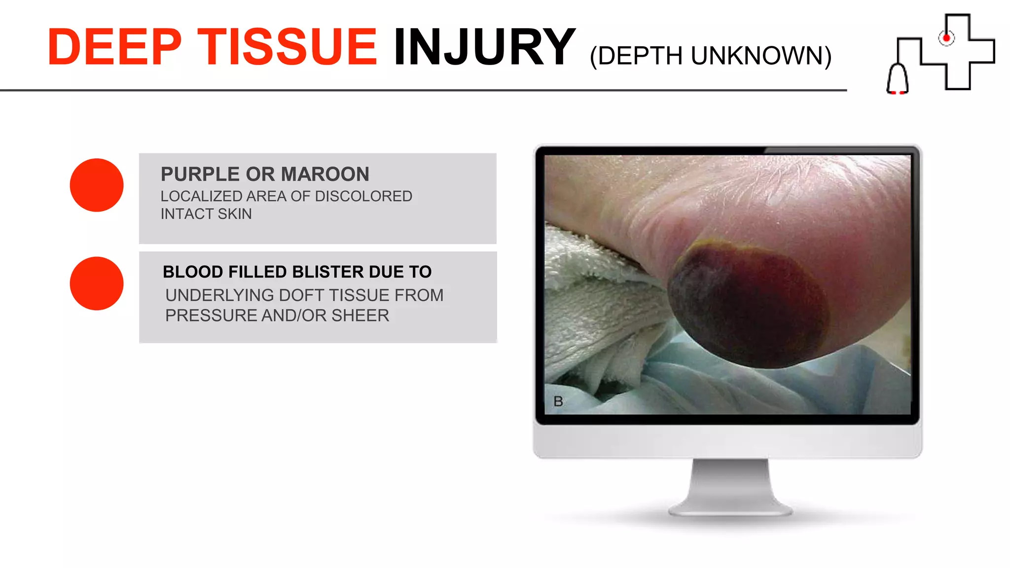 DEEP TISSUE INJURY (DEPTH UNKNOWN)
LOCALIZED AREA OF DISCOLORED
INTACT SKIN
PURPLE OR MAROON
BLOOD FILLED BLISTER DUE TO
UNDERLYING DOFT TISSUE FROM
PRESSURE AND/OR SHEER
 