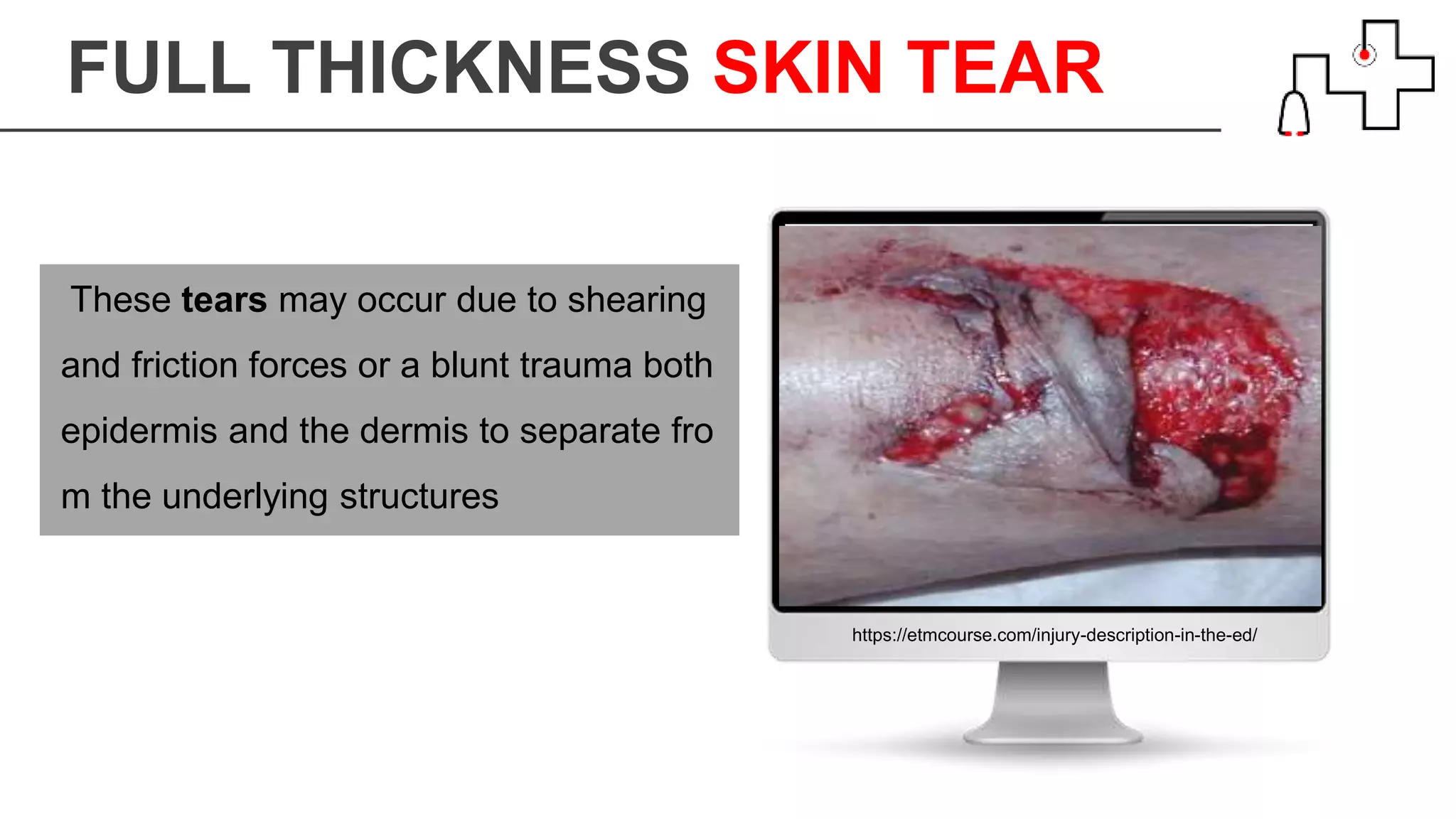 FULL THICKNESS SKIN TEAR
https://etmcourse.com/injury-description-in-the-ed/
These tears may occur due to shearing
and friction forces or a blunt trauma both
epidermis and the dermis to separate fro
m the underlying structures
 