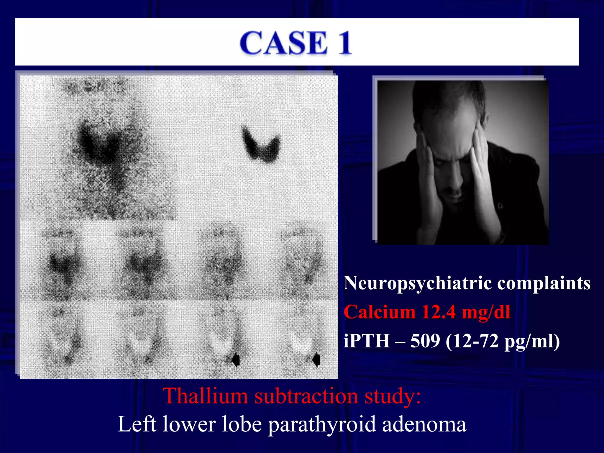 Neuropsychiatric complaints
Calcium 12.4 mg/dl
iPTH – 509 (12-72 pg/ml)

Thallium subtraction study:
Left lower lobe parathyroid adenoma

 