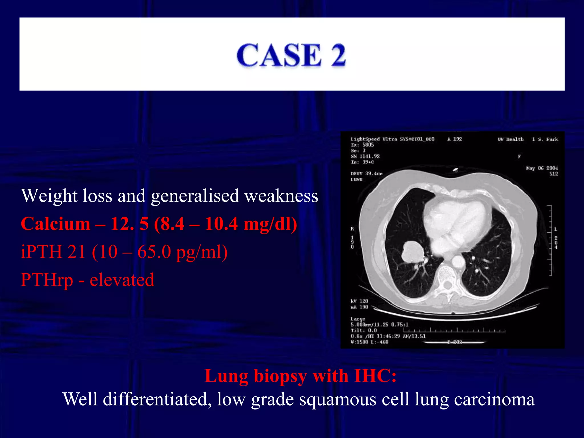 Weight loss and generalised weakness
Calcium – 12. 5 (8.4 – 10.4 mg/dl)
iPTH 21 (10 – 65.0 pg/ml)
PTHrp - elevated

Lung biopsy with IHC:
Well differentiated, low grade squamous cell lung carcinoma

 