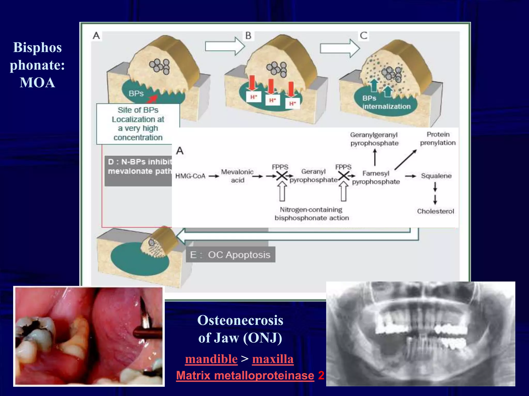 Bisphos
phonate:
MOA

Osteonecrosis
of Jaw (ONJ)
mandible > maxilla
Matrix metalloproteinase 2

 