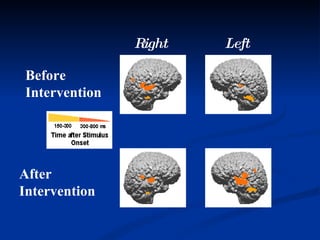 Before Intervention After Intervention Left Right 