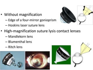 • Without magnification
– Edge of a four-mirror gonioprism
– Hoskins laser suture lens
• High-magnification suture lysis contact lenses
– Mandlekorn lens
– Blumenthal lens
– Ritch lens
 