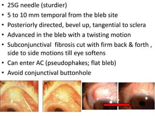 • 25G needle (sturdier)
• 5 to 10 mm temporal from the bleb site
• Posteriorly directed, bevel up, tangential to sclera
• Advanced in the bleb with a twisting motion
• Subconjunctival fibrosis cut with firm back & forth ,
side to side motions till eye softens
• Can enter AC (pseudophakes; flat bleb)
• Avoid conjunctival buttonhole
 