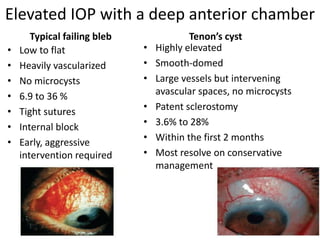 Elevated IOP with a deep anterior chamber
Typical failing bleb
• Low to flat
• Heavily vascularized
• No microcysts
• 6.9 to 36 %
• Tight sutures
• Internal block
• Early, aggressive
intervention required
Tenon’s cyst
• Highly elevated
• Smooth-domed
• Large vessels but intervening
avascular spaces, no microcysts
• Patent sclerostomy
• 3.6% to 28%
• Within the first 2 months
• Most resolve on conservative
management
 