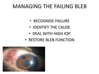 MANAGING THE FAILING BLEB
• RECOGNISE FAILURE
• IDENTIFY THE CAUSE
• DEAL WITH HIGH IOP
• RESTORE BLEB FUNCTION
 
