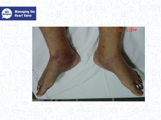 Managing the heart value