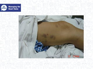 Managing the heart value