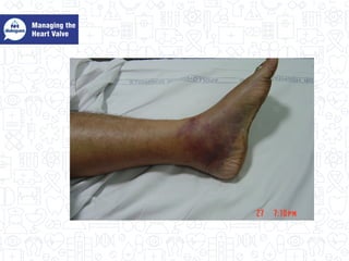 Managing the heart value