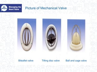 Picture of Mechanical Valve
Tilting disc valve Ball and cage valveBileaflet valve
 