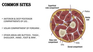 Managment of compartment syndrome. pptx | PPTX
