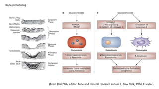 Managment of glucocorticoids induced osteoprosis | PPTX