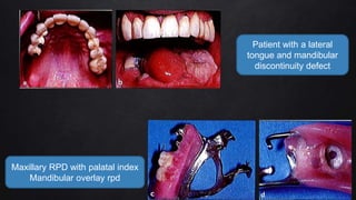 Mandiblar Rpd Managment of hamimandibulectomy | PPTX