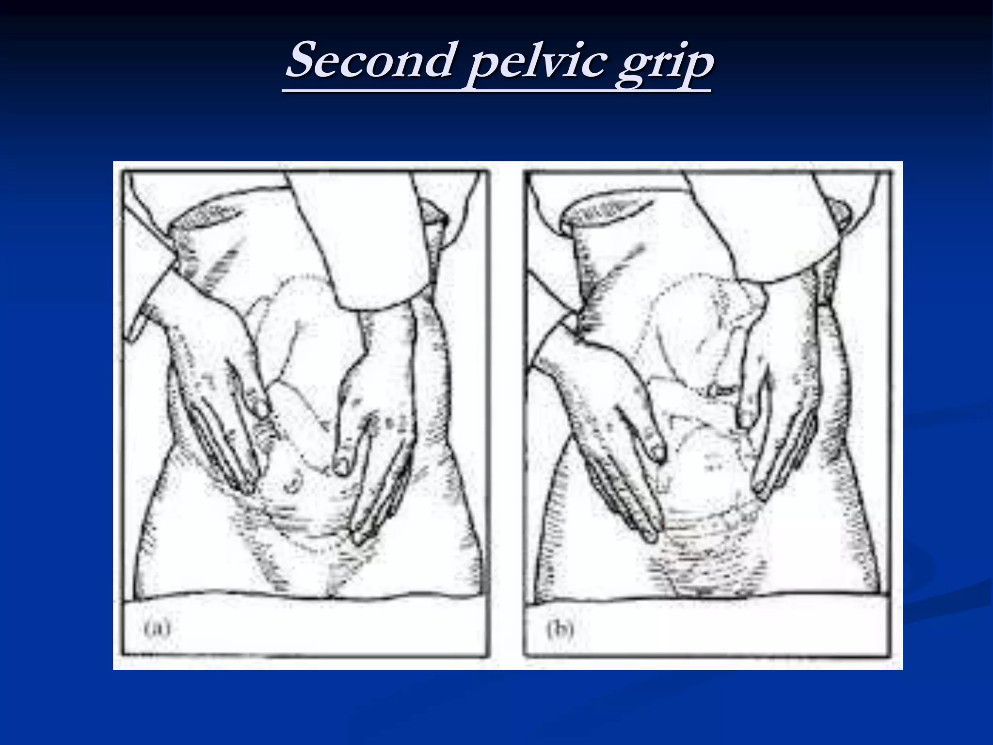 Second pelvic grip
 