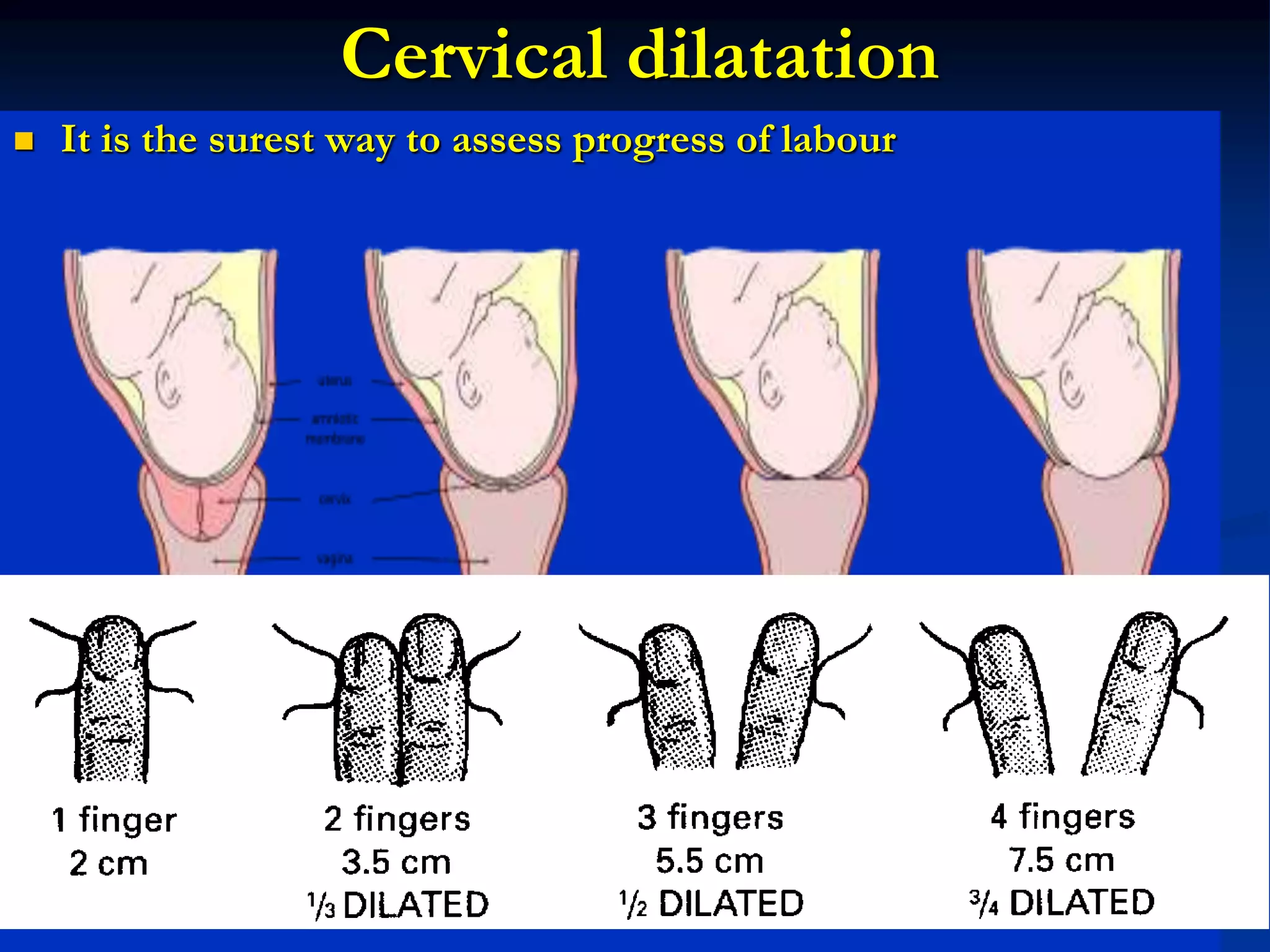 Cervical dilatation
 It is the surest way to assess progress of labour
 