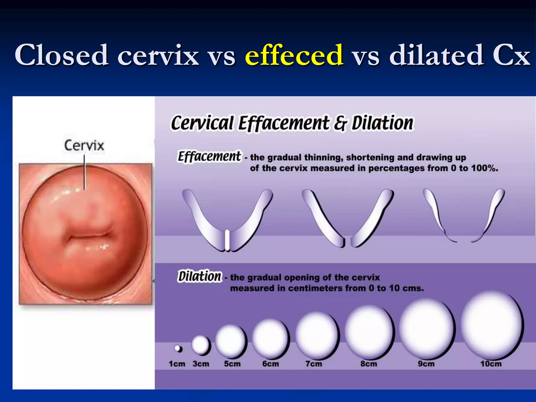 Closed cervix vs effeced vs dilated Cx
 