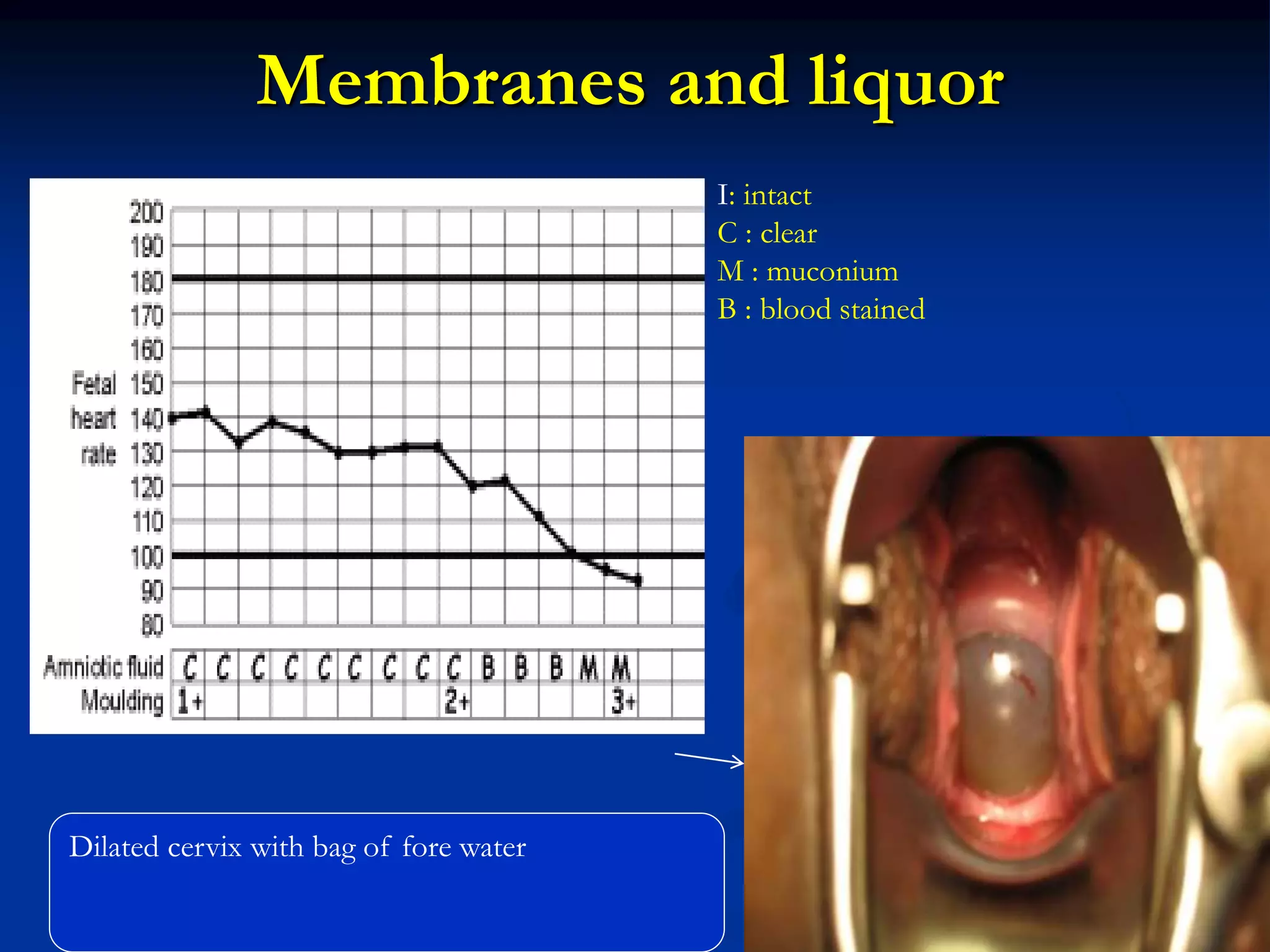 Membranes and liquor
Dilated cervix with bag of fore water
I: intact
C : clear
M : muconium
B : blood stained
 