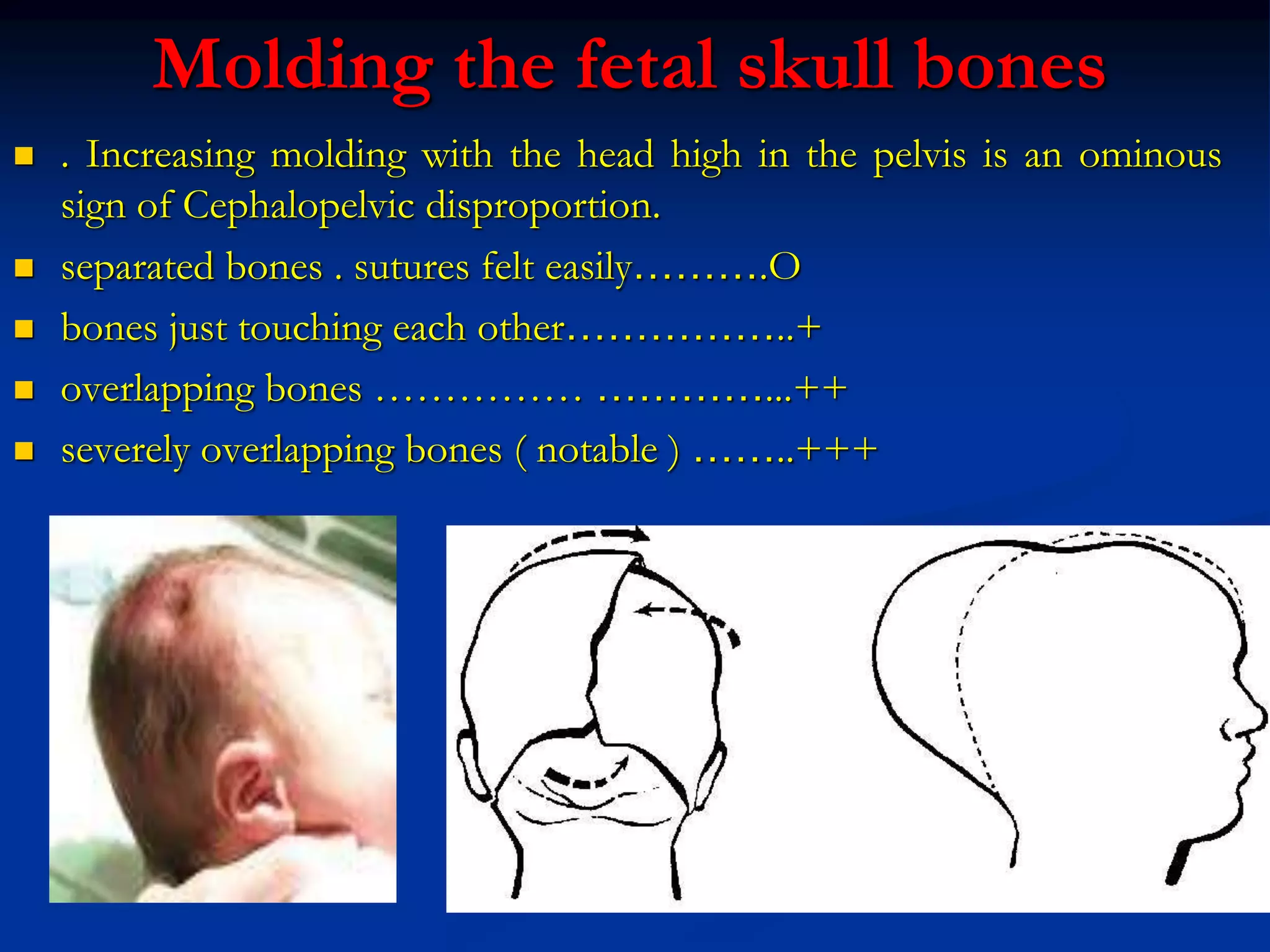 Molding the fetal skull bones
 . Increasing molding with the head high in the pelvis is an ominous
sign of Cephalopelvic disproportion.
 separated bones . sutures felt easily……….O
 bones just touching each other……………..+
 overlapping bones …………… …………...++
 severely overlapping bones ( notable ) ……..+++
 
