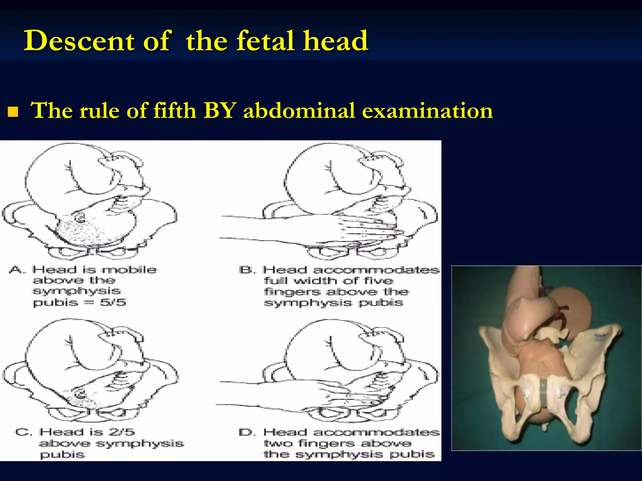Descent of the fetal head
 The rule of fifth BY abdominal examination
 