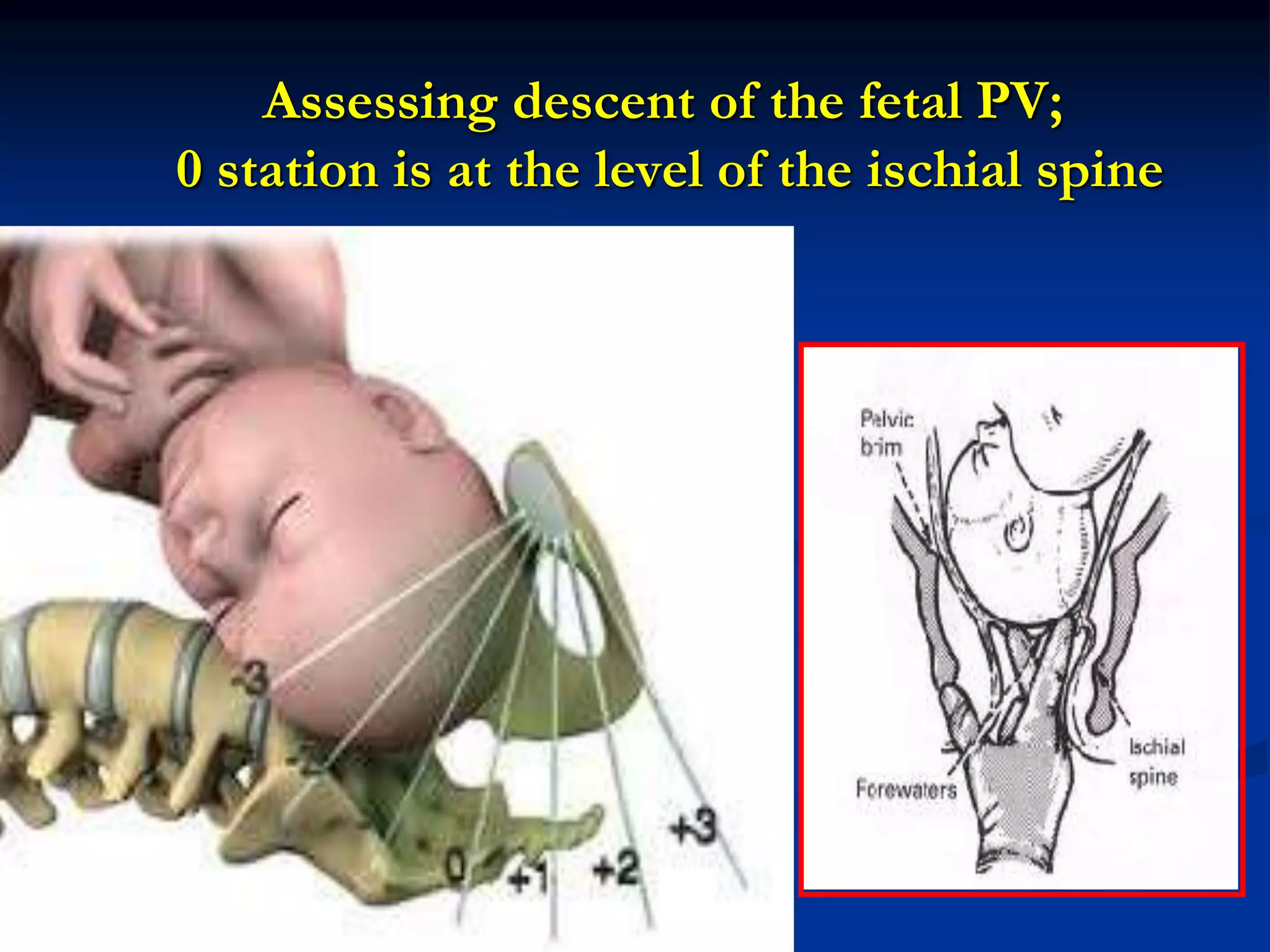 Assessing descent of the fetal PV;
0 station is at the level of the ischial spine
 