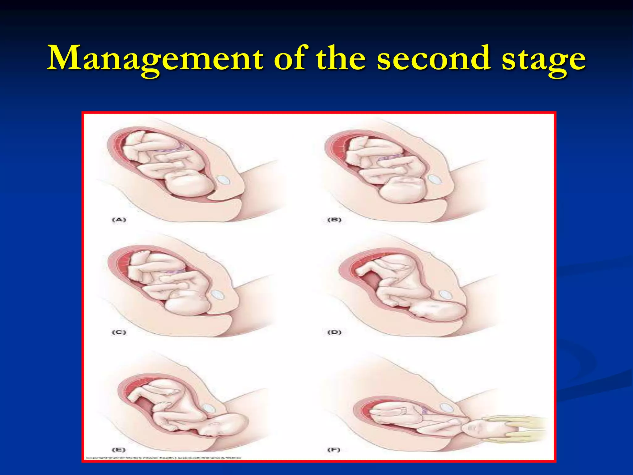 Management of the second stage
 
