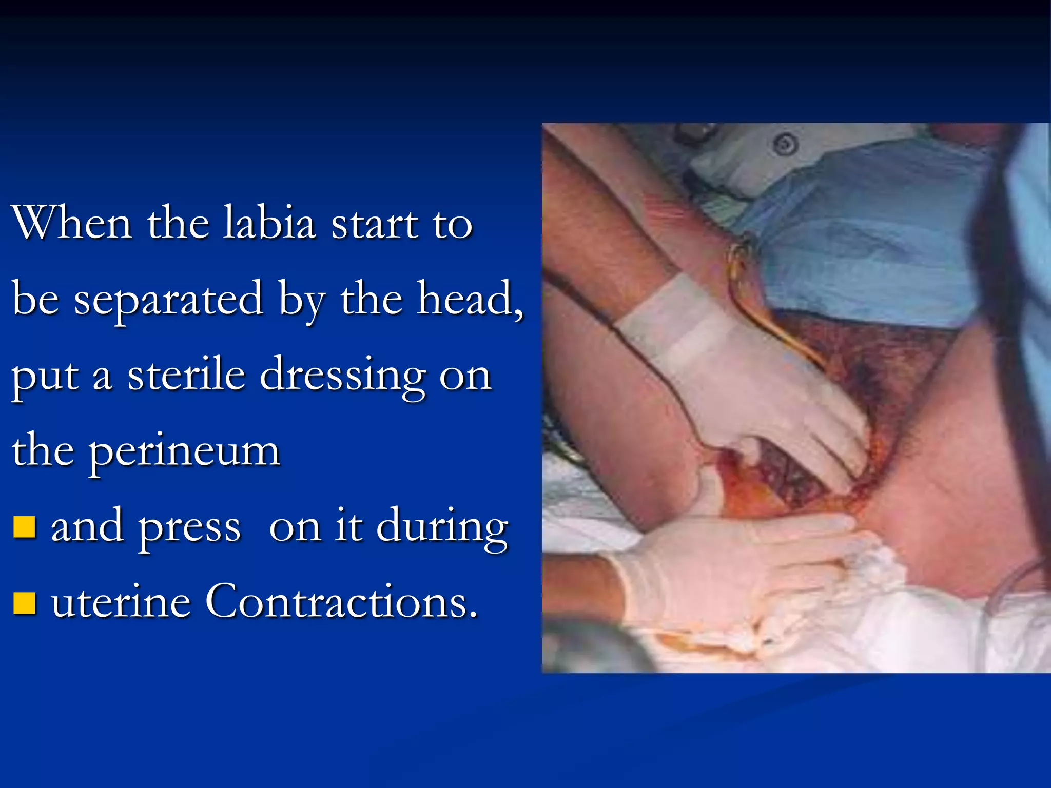 When the labia start to
be separated by the head,
put a sterile dressing on
the perineum
 and press on it during
 uterine Contractions.
 