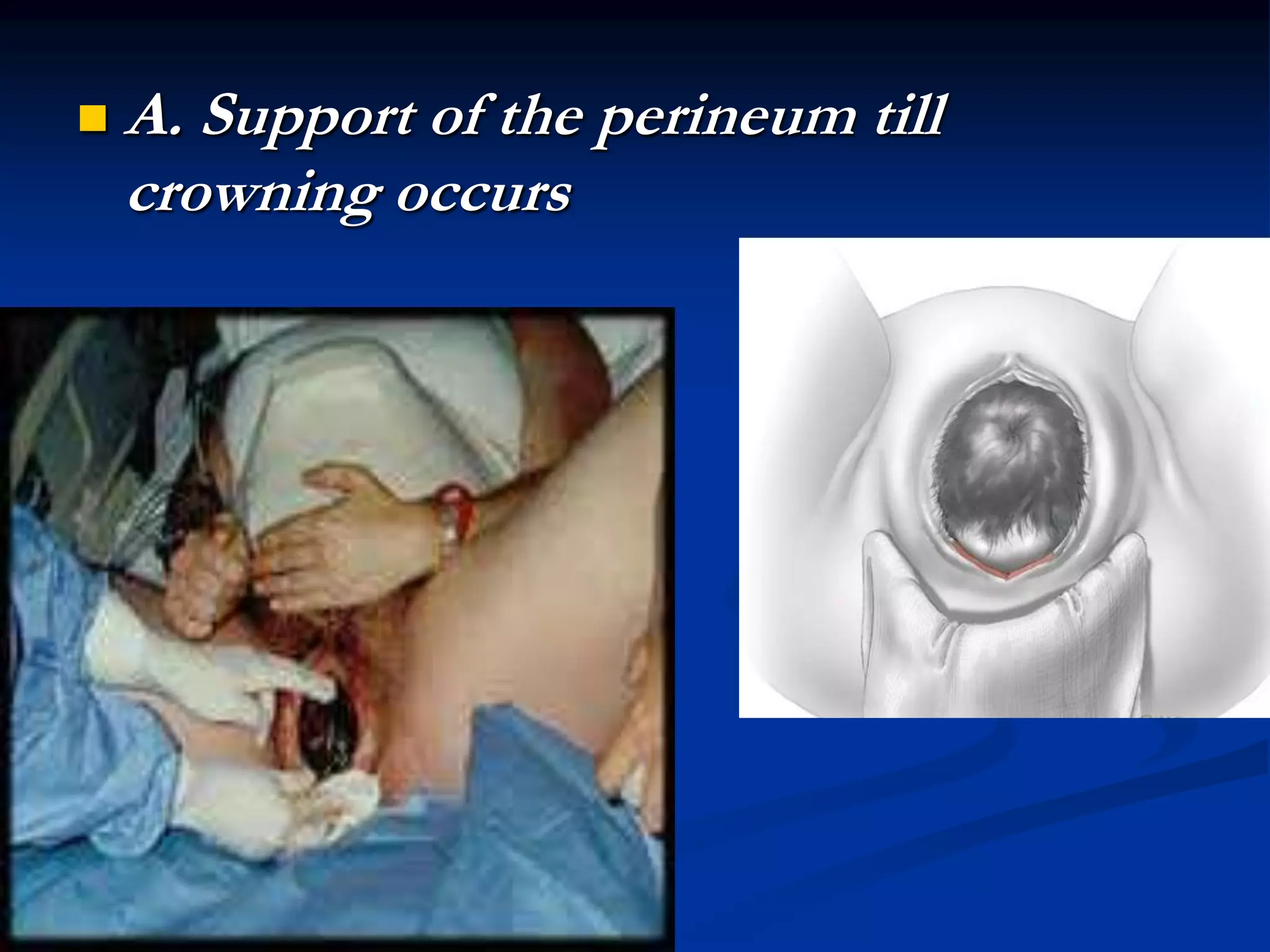  A. Support of the perineum till
crowning occurs
 