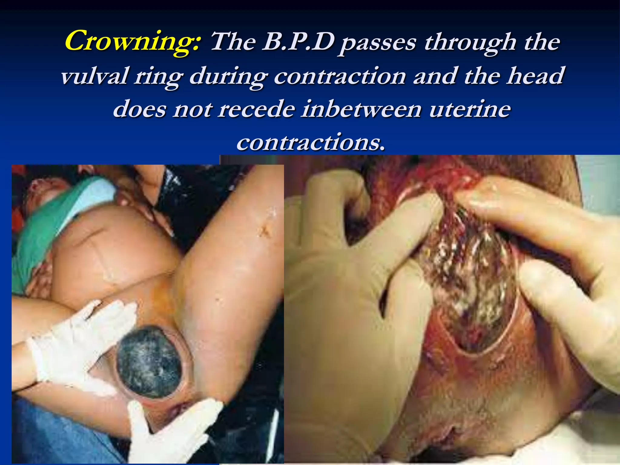 Crowning: The B.P.D passes through the
vulval ring during contraction and the head
does not recede inbetween uterine
contractions.
 
