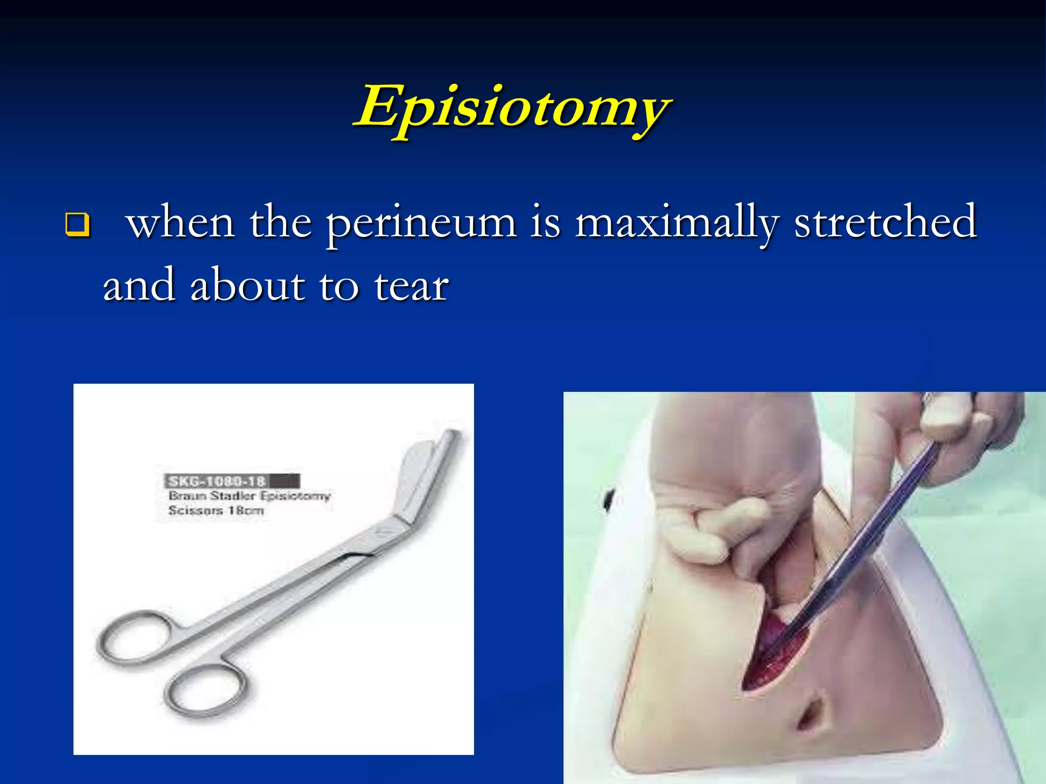 Episiotomy
 when the perineum is maximally stretched
and about to tear
 