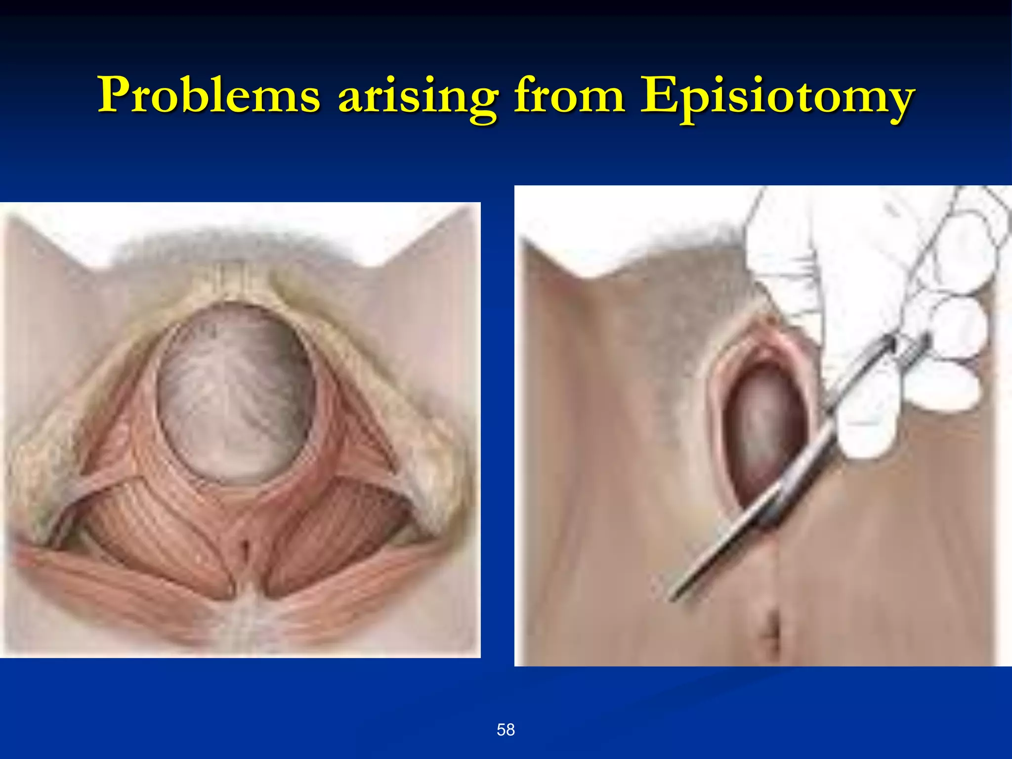 Problems arising from Episiotomy
58
 Pain
 Edema
 Bleeding
 Infection
 Defects in wound
 