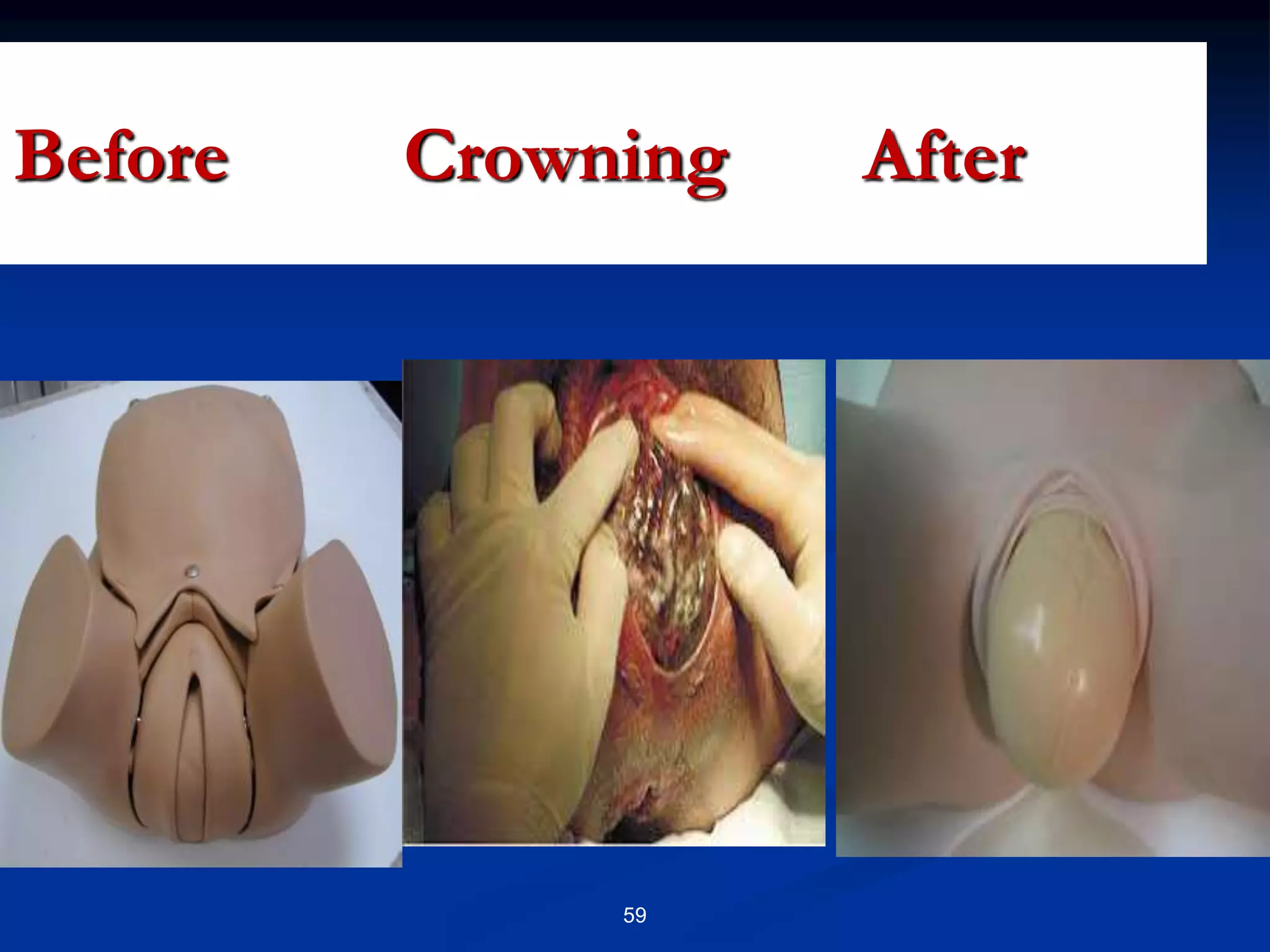 Before Crowning After
59
 