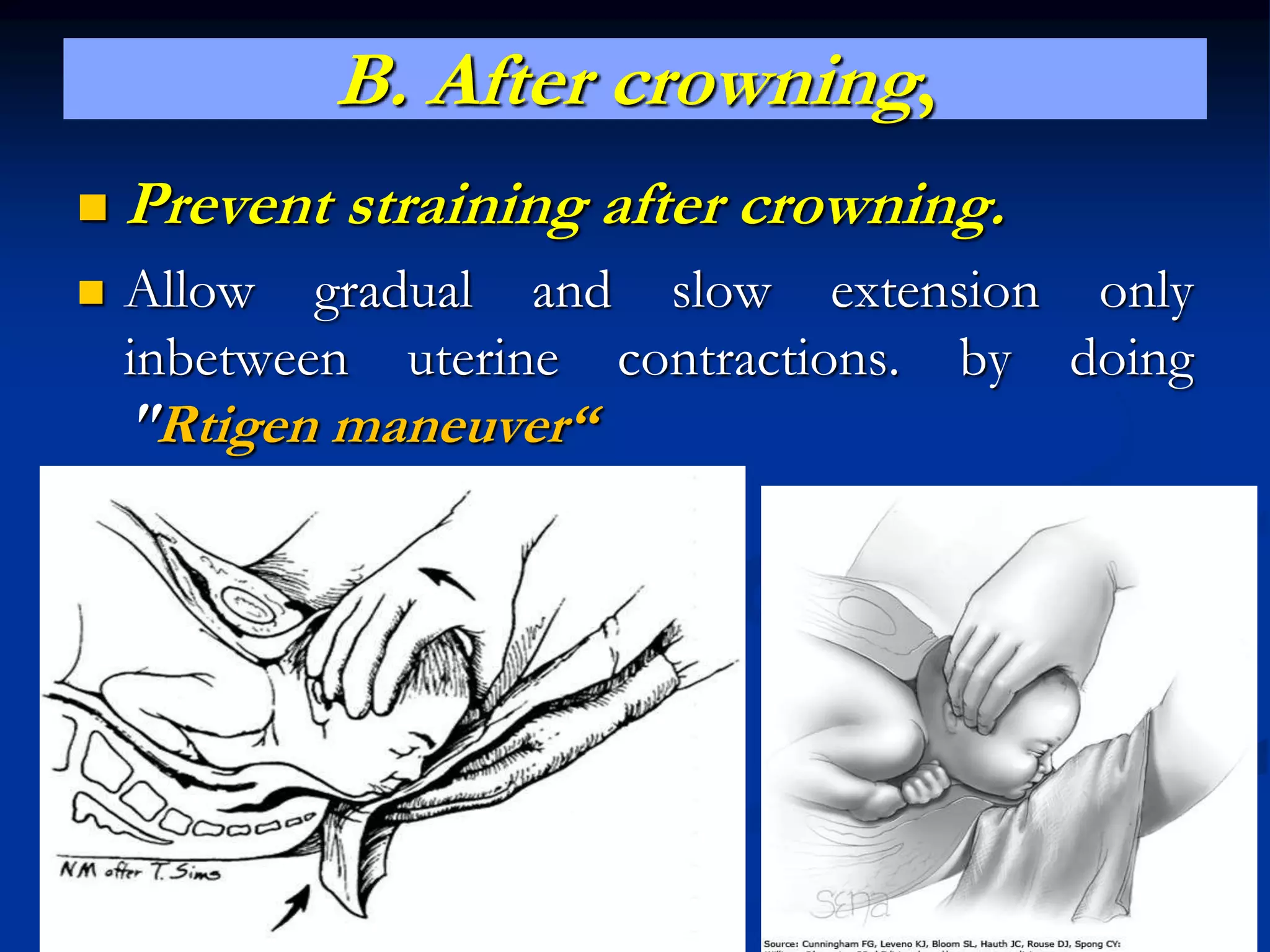 B. After crowning,
 Prevent straining after crowning.
 Allow gradual and slow extension only
inbetween uterine contractions. by doing
"Rtigen maneuver“
 