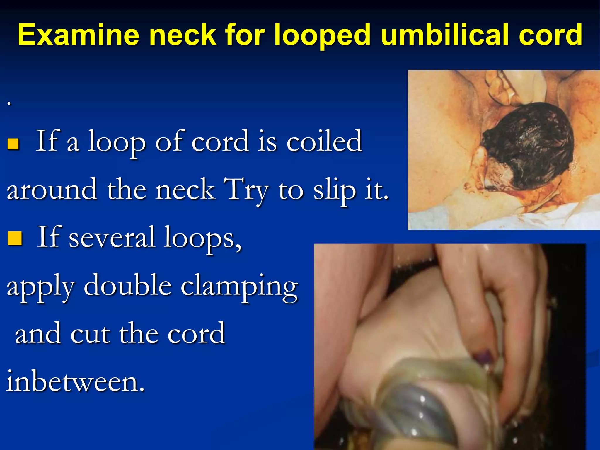 Examine neck for looped umbilical cord
.
 If a loop of cord is coiled
around the neck Try to slip it.
 If several loops,
apply double clamping
and cut the cord
inbetween.
 