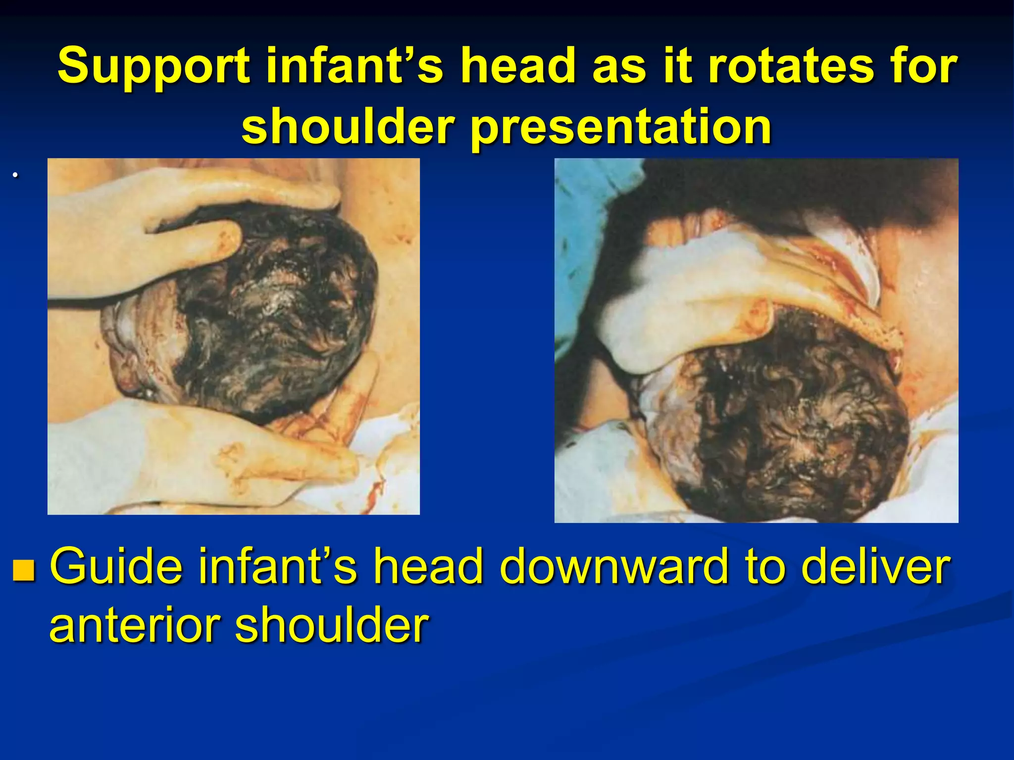 Support infant’s head as it rotates for
shoulder presentation
.
 Guide infant’s head downward to deliver
anterior shoulder
 