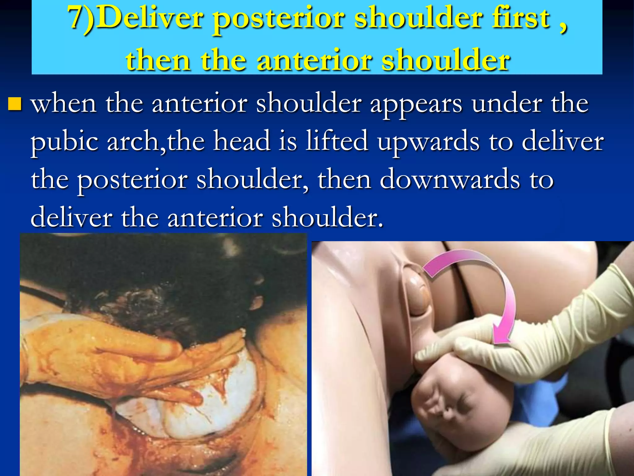 7)Deliver posterior shoulder first ,
then the anterior shoulder
 when the anterior shoulder appears under the
pubic arch,the head is lifted upwards to deliver
the posterior shoulder, then downwards to
deliver the anterior shoulder.
 