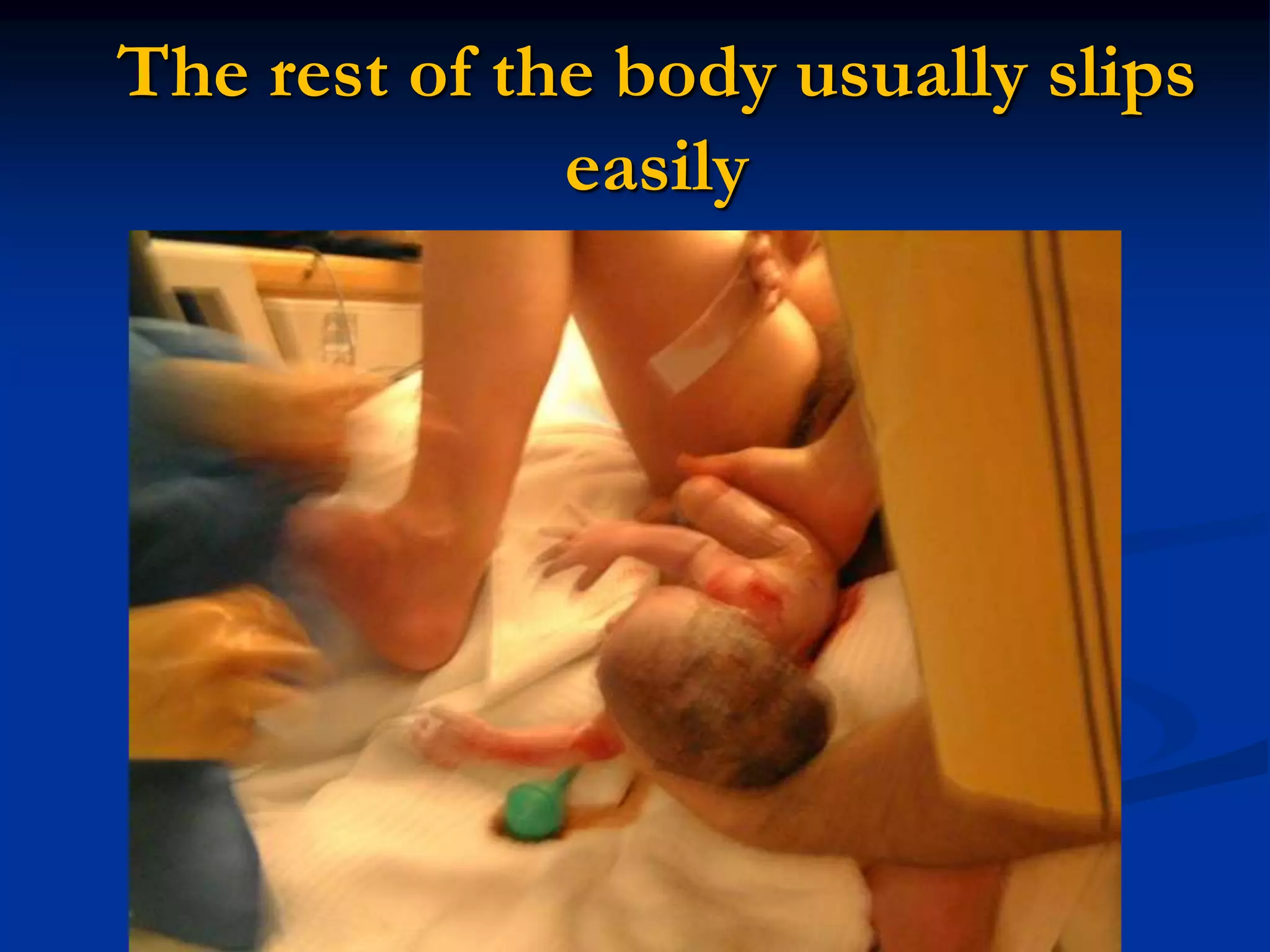The rest of the body usually slips
easily
 