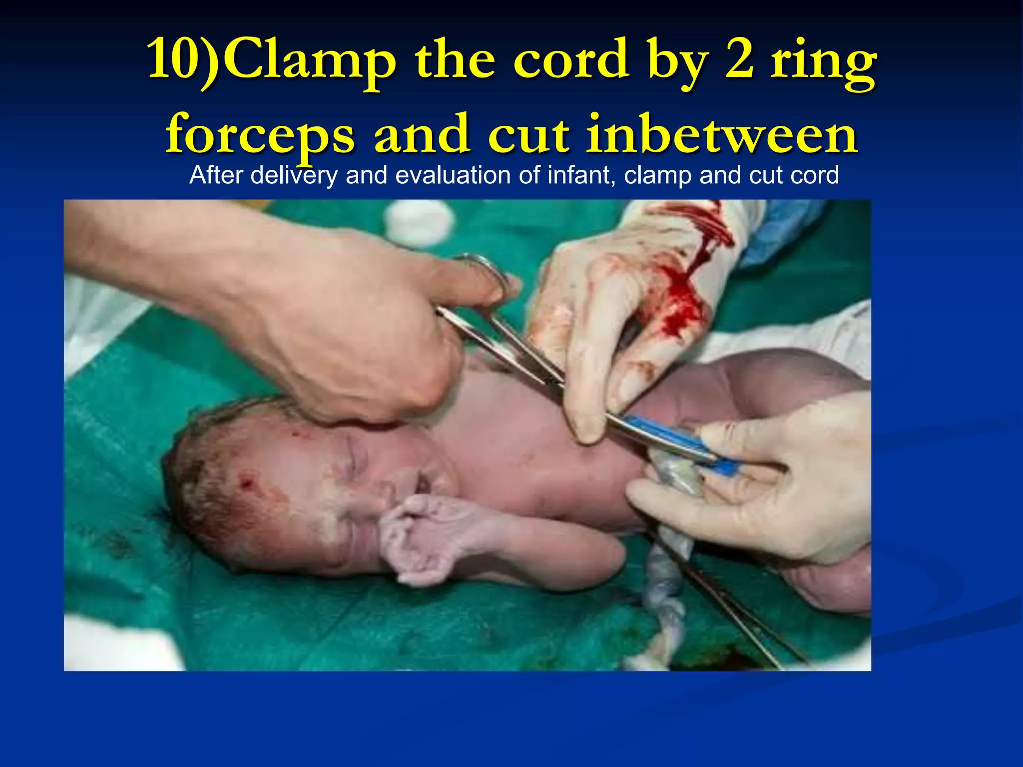 10)Clamp the cord by 2 ring
forceps and cut inbetween
After delivery and evaluation of infant, clamp and cut cord
 