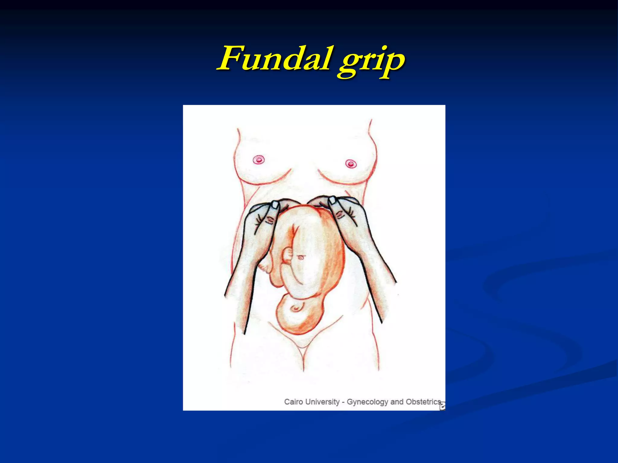 Fundal grip
 