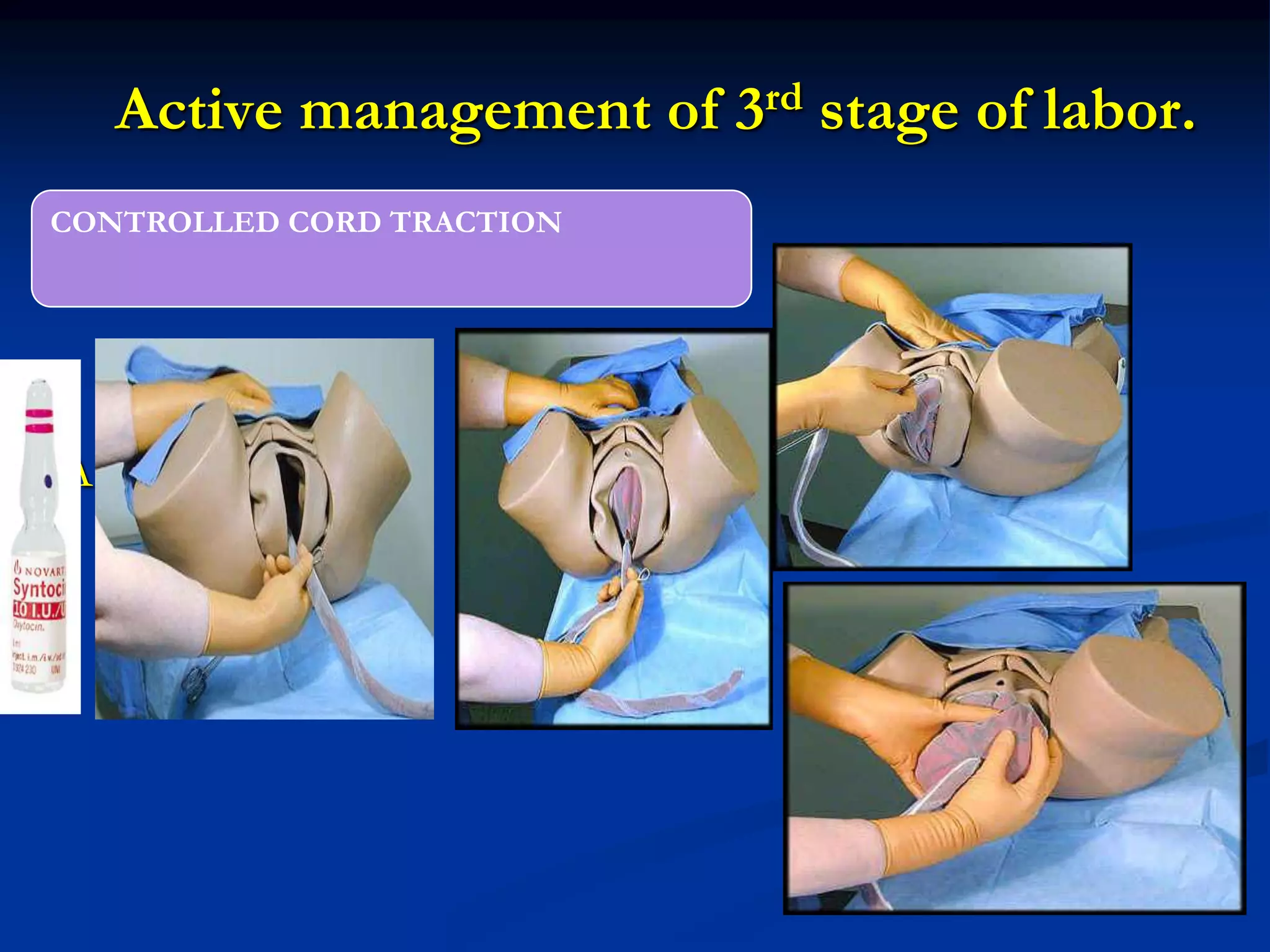 Active management of 3rd stage of labor.
A
CONTROLLED CORD TRACTION
 