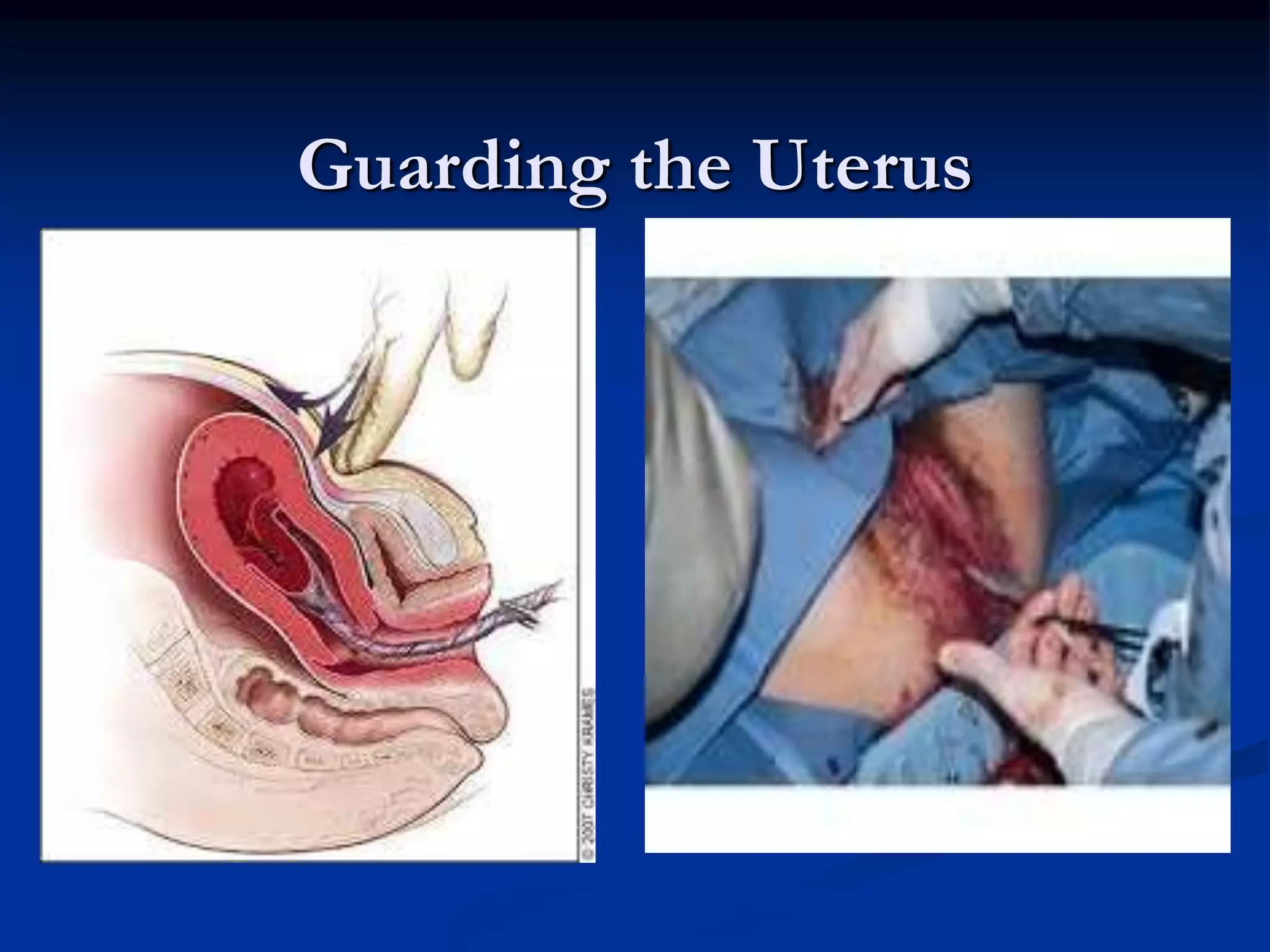 Guarding the Uterus
 