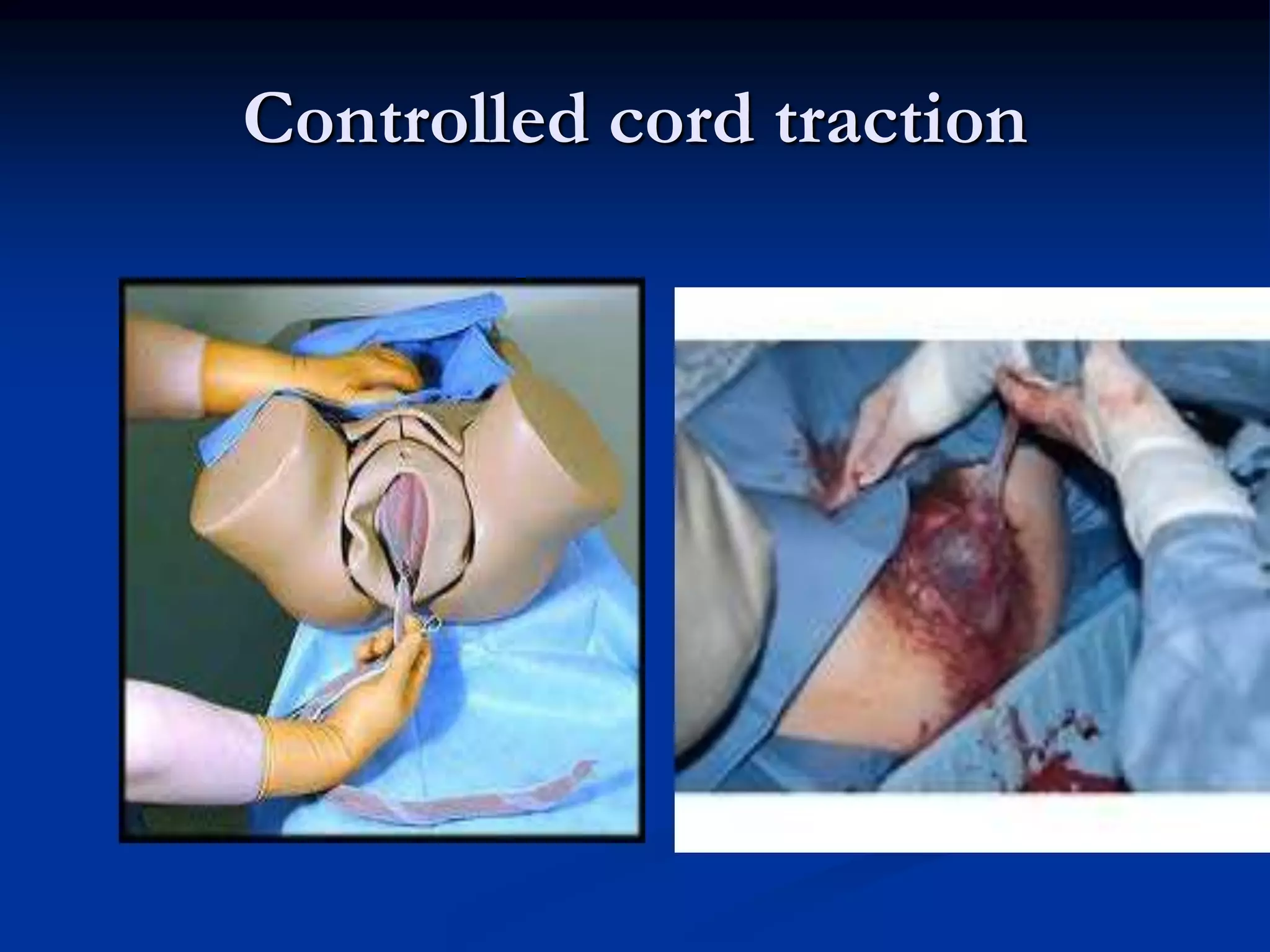 Controlled cord traction
 